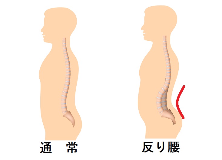 腰痛の原因に多い 反り腰 改善方法